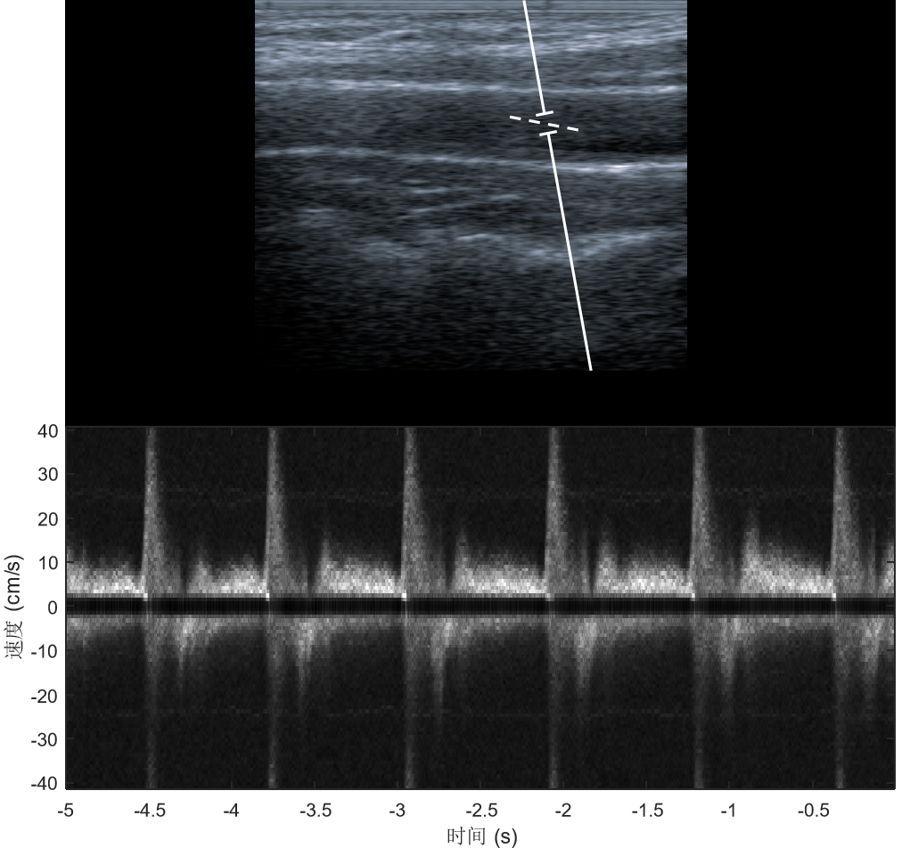 超快频谱多普勒