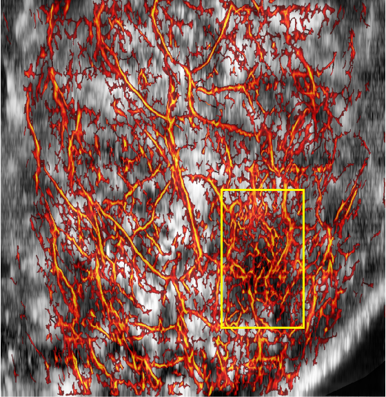 人体全乳腺光声超声双模态融合图像